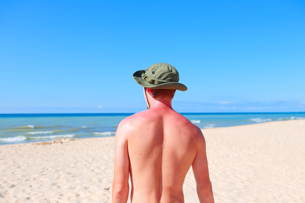 Man with a sunburned back walking on the beach, illustrating the importance of proper sun protection to prevent skin damage.