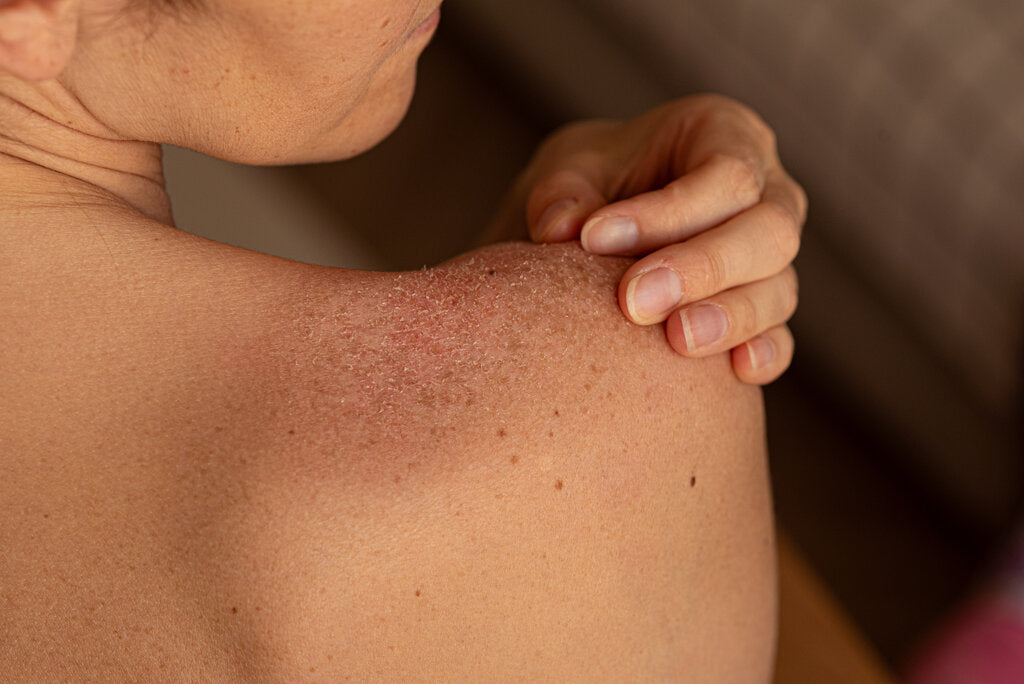Close-up of peeling, sun-damaged skin on a shoulder, illustrating how repeated sunburns can increase the risk of skin cancer and the importance of sun protection.
