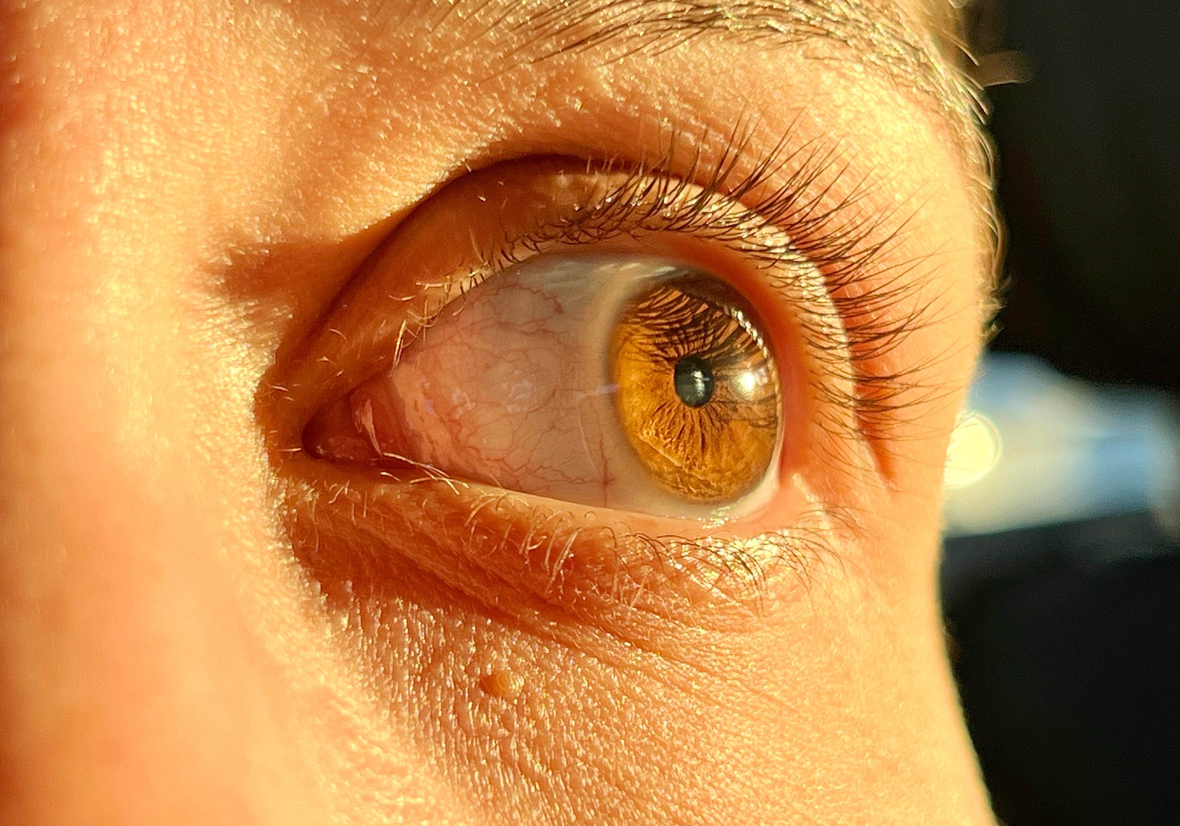 Detailed close-up of a human eye in direct sunlight, illustrating the potential long-term effects of UV damage on eye health.