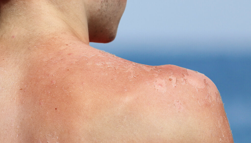 Close-up of a person’s sunburned and peeling shoulder, illustrating the painful aftermath of UV overexposure and the need for daily sun protection like UPF clothing and sunscreen.