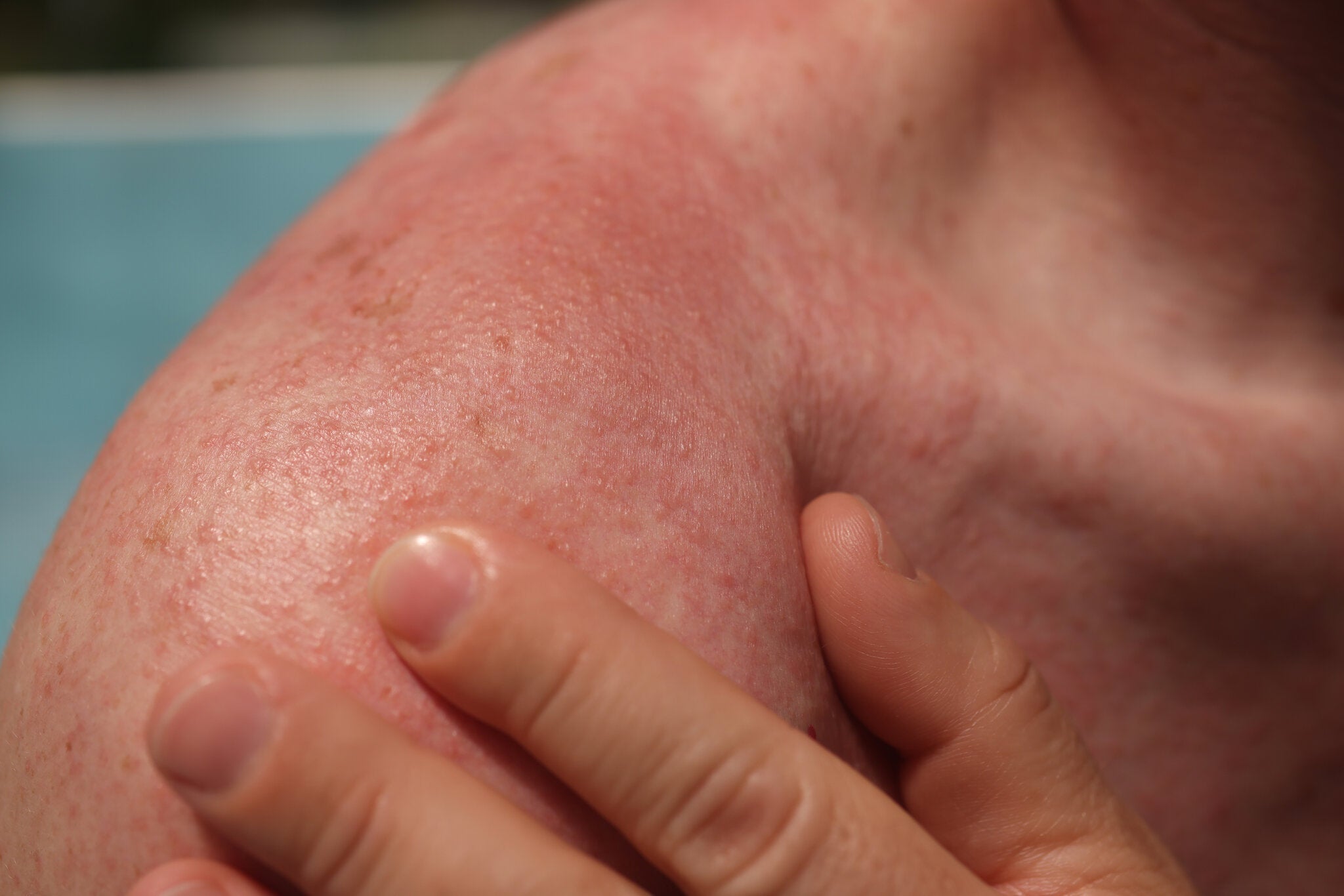 Close-up of a red, irritated shoulder with rough skin texture, indicating a possible sunburn or sun allergy reaction.
