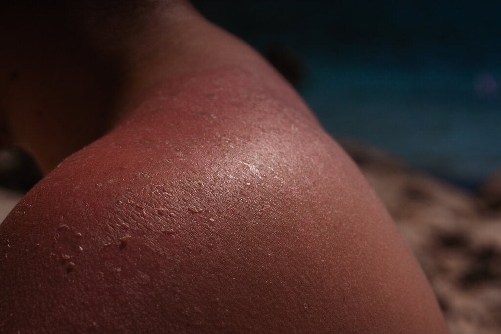 Severely sunburned shoulder with small blisters forming, a sign of sun poisoning