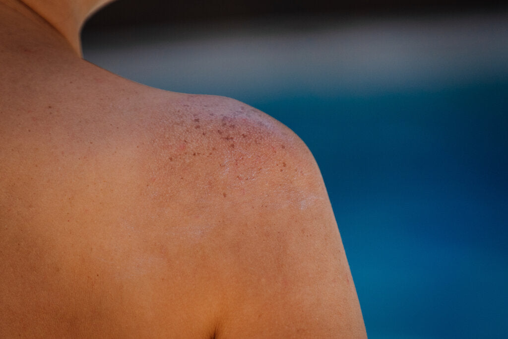 Close-up of a person’s shoulder showing visible sun damage, including redness, dryness, and uneven pigmentation, illustrating the long-term effects of UV exposure on skin health.