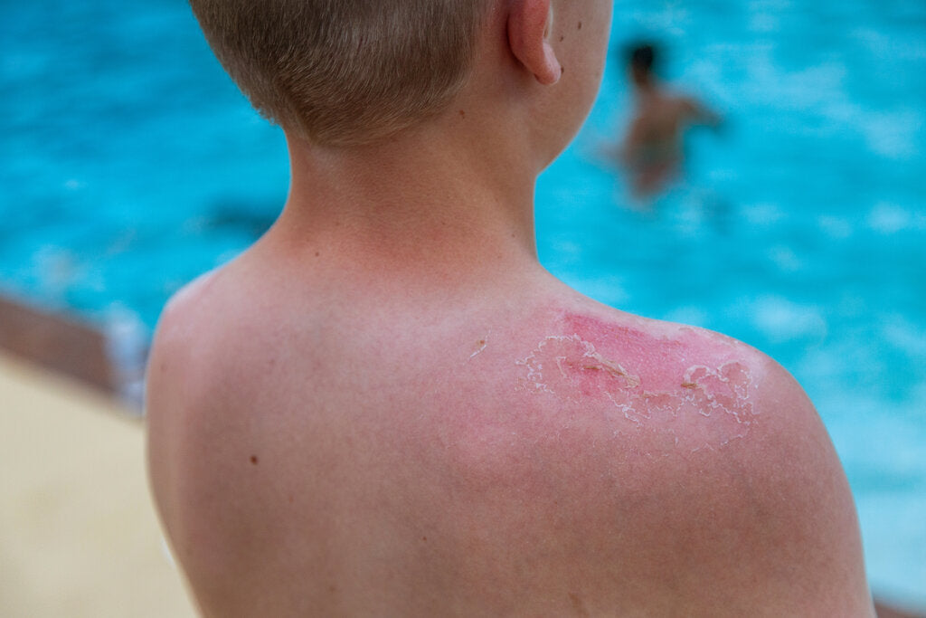 Red, peeling sunburn on a boy's shoulder at a swimming pool.