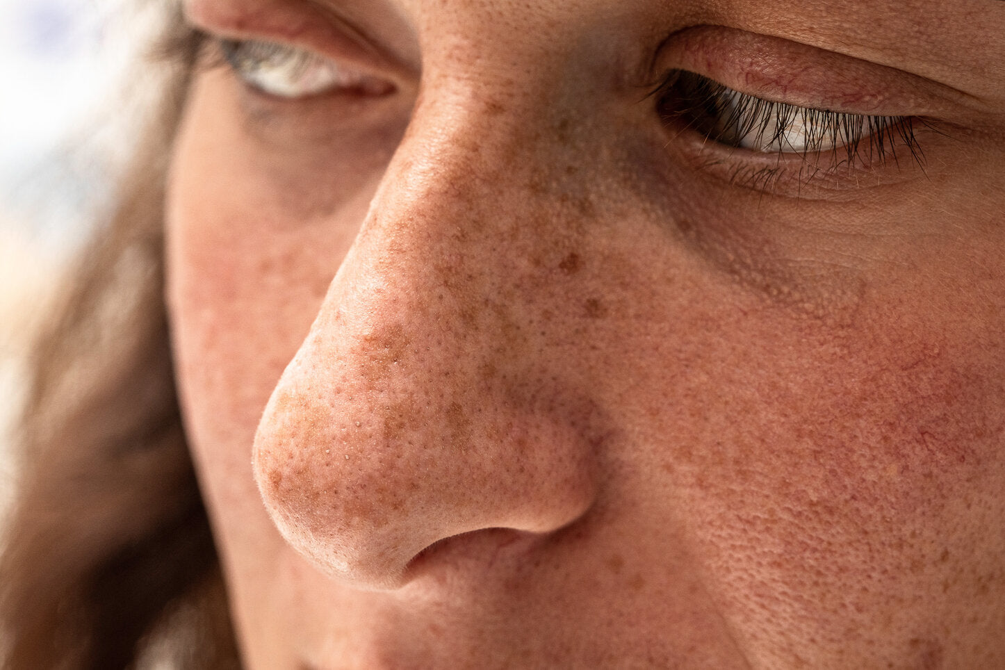 Close-up of a woman’s face showing freckles and sun-damaged skin, emphasizing the effects of prolonged sun exposure.
